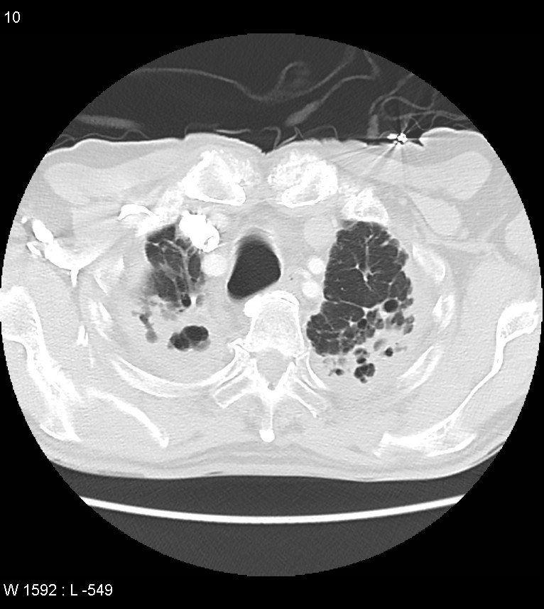 Asbestos related lung and pleural disease (Radiopaedia 14377-14301 A 7).jpg