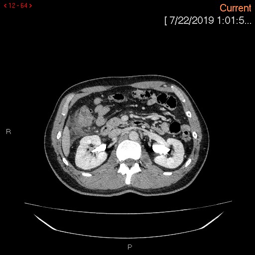 Ascending colonic diverticulum mimicking acute appendicitis (Radiopaedia 69943-80198 A 64).jpg