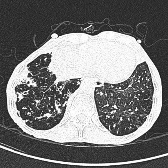 Aspergilloma- with Monod sign (Radiopaedia 44737-48532 Axial lung window 236).jpg