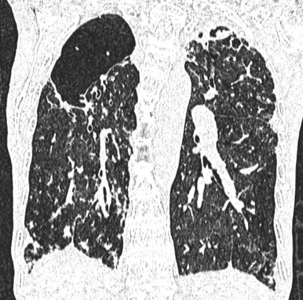 Aspergilloma- with Monod sign (Radiopaedia 44737-48532 Coronal lung window 309).jpg