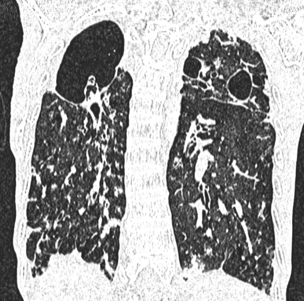 Aspergilloma- with Monod sign (Radiopaedia 44737-48532 Coronal lung window 329).jpg