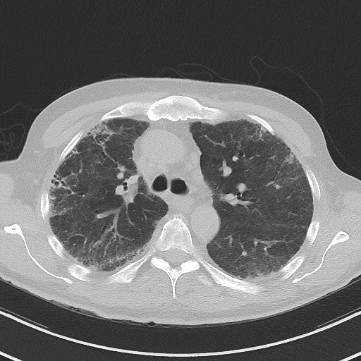 Aspergilloma on background pulmonary fibrosis (Radiopaedia 60942-68757 A 21).jpg