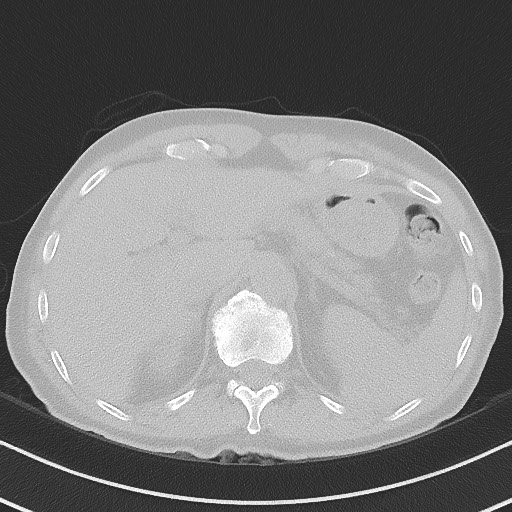 Aspergilloma on background pulmonary fibrosis (Radiopaedia 60942-68757 A 55).jpg