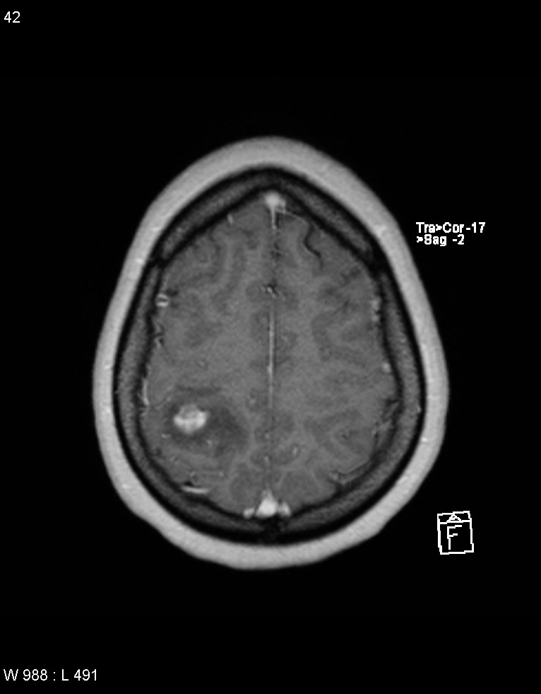 Astroblastoma (Radiopaedia 39792-42217 Axial T1 C+ 41).jpg