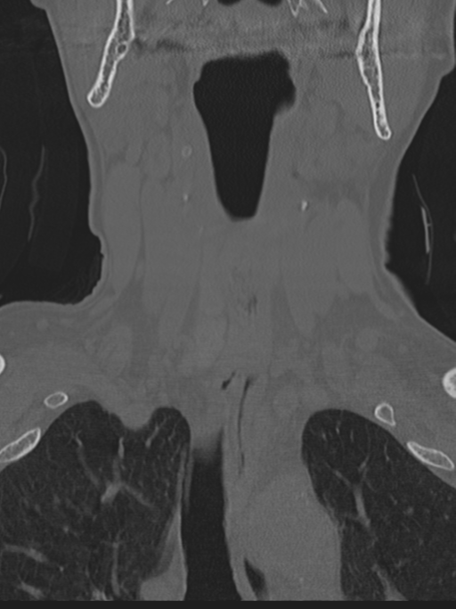 Atlanto-axial subluxation (Radiopaedia 36610-38176 Coronal bone window 8).png