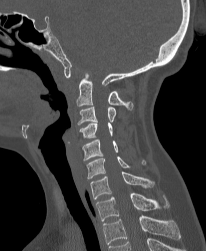 Atlanto-occipital assimilation with basilar invagination (Radiopaedia 70122-80188 Sagittal bone window 77).jpg