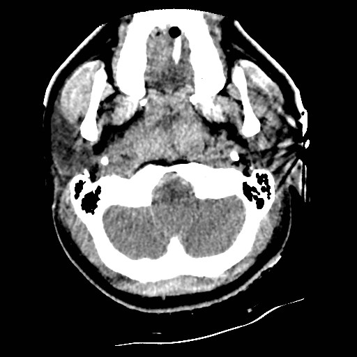 Atlanto-occipital dislocation (Radiopaedia 44648-48412 Axial non-contrast 8).jpg