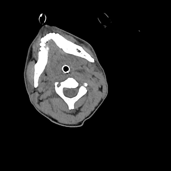 File:Atlanto-occipital dissociation (Traynelis type 1), C2 teardrop fracture, C6-7 facet joint dislocation (Radiopaedia 87655-104061 Axial non-contrast 26).jpg