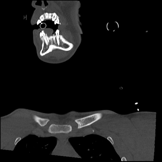 Atlanto-occipital dissociation (Traynelis type 1), C2 teardrop fracture, C6-7 facet joint dislocation (Radiopaedia 87655-104061 Coronal bone window 6).jpg