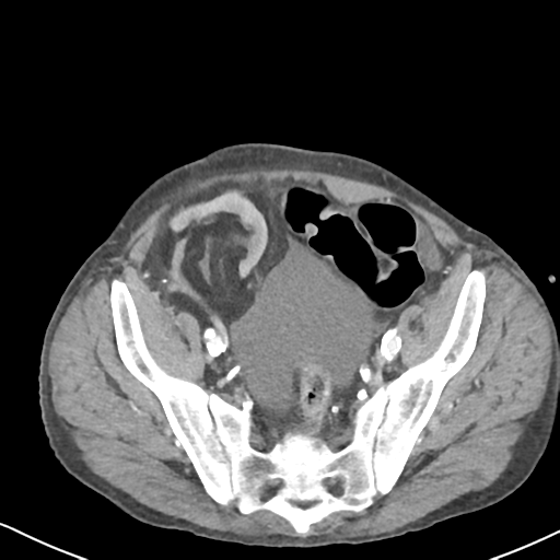 Atraumatic splenic rupture (Radiopaedia 42931-46160 A 69).png