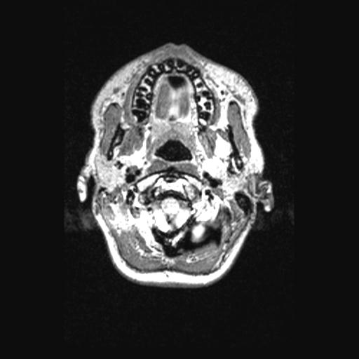 Atretic encephalocoele with inferior vermis hypoplasia (Radiopaedia 30443-31108 Axial 17).jpg