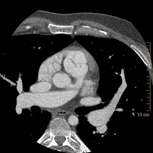 Atrial septal defect (upper sinus venosus type) with partial anomalous pulmonary venous return into superior vena cava (Radiopaedia 73228-83961 A 85).jpg