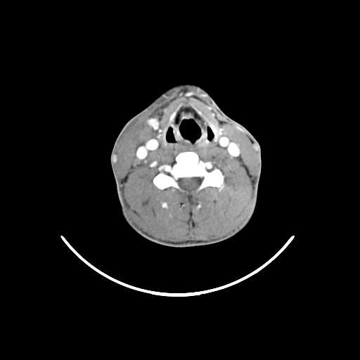 File:Atypical 2nd branchial cleft cyst (type IV) - infected (Radiopaedia 20986-20924 A 18).jpg