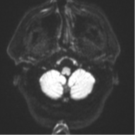 File:Atypical meningioma (WHO grade II) with brain invasion (Radiopaedia 57767-64729 Axial DWI 34).png