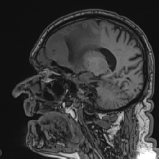 Atypical meningioma (WHO grade II) with brain invasion (Radiopaedia 57767-64729 Sagittal T1 42).png