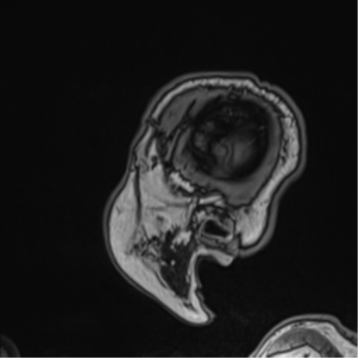 File:Atypical meningioma (WHO grade II) with brain invasion (Radiopaedia 57767-64729 Sagittal T1 60).png