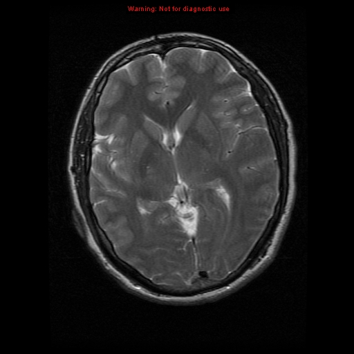 File:Atypical meningioma - grade II (Radiopaedia 13303-13305 Axial T2 11).jpg