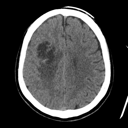 Atypical meningioma with skull invasion (Radiopaedia 34357-35649 Axial non-contrast 36).png