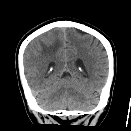 Atypical meningioma with skull invasion (Radiopaedia 34357-35649 Coronal non-contrast 45).png