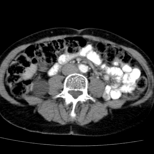 File:Atypical renal cyst (Radiopaedia 17536-17251 renal cortical phase 28).jpg