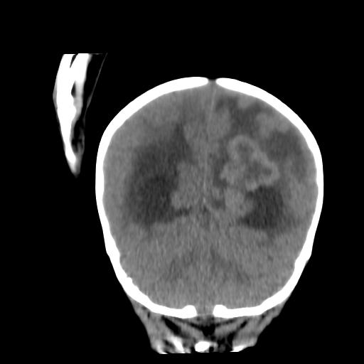 Atypical teratoid rhabdoid tumor (AT-RT) (Radiopaedia 85823-101654 Coronal non-contrast 40).jpg