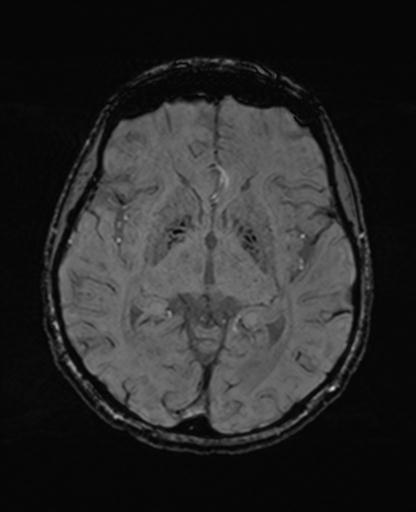 Autoimmune limbic encephalitis (Radiopaedia 30363-31005 SWI 37).jpg