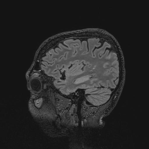 Autoimmune limbic encephalitis (Radiopaedia 30363-31005 Sagittal FLAIR 116).jpg