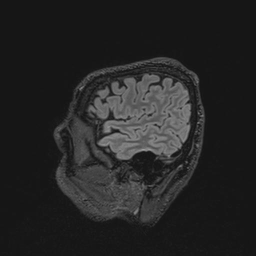 Autoimmune limbic encephalitis (Radiopaedia 30363-31005 Sagittal FLAIR 30).jpg