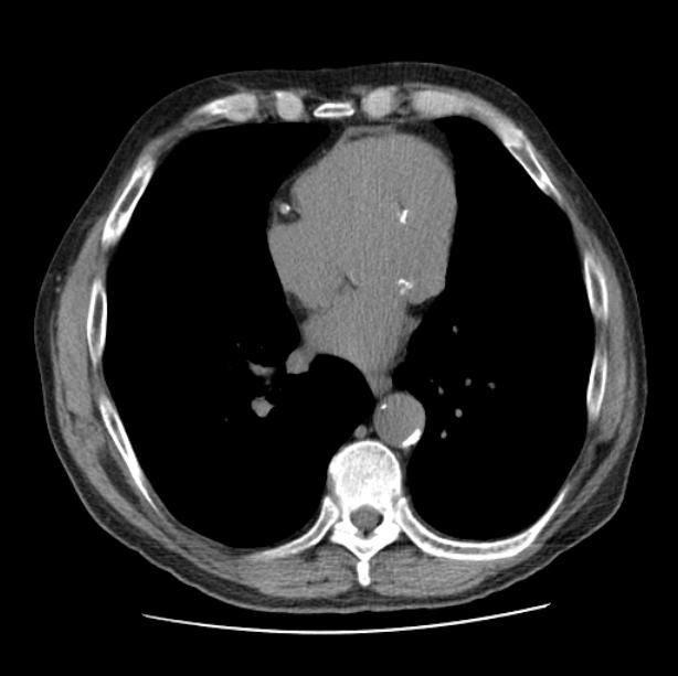 Autosomal dominant polycystic kidney disease (Radiopaedia 27851-28094 Axial non-contrast 36).jpg
