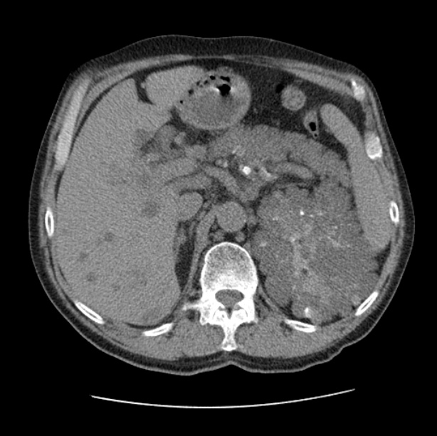 Autosomal dominant polycystic kidney disease (Radiopaedia 27851-28094 Axial non-contrast 59).jpg