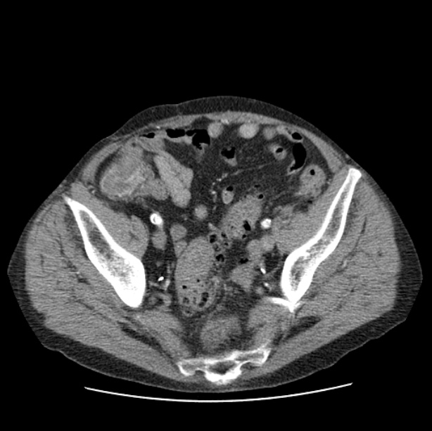 Autosomal dominant polycystic kidney disease (Radiopaedia 27851-28094 B 104).jpg