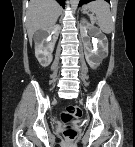 Autosomal dominant polycystic kidney disease (Radiopaedia 38189-40194 Coronal C+ delayed 66).jpg