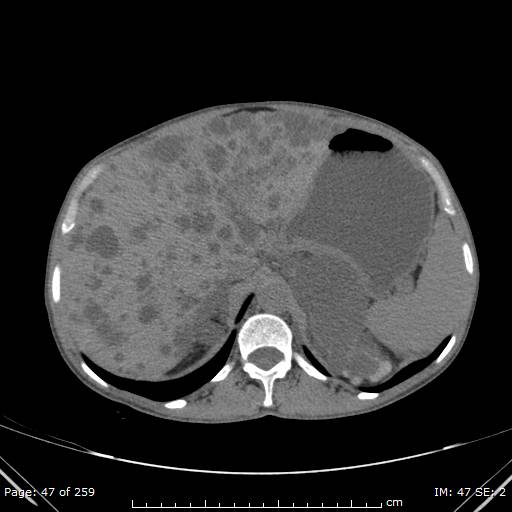 File:Autosomal dominant polycystic kidney disease (Radiopaedia 44122-47684 Axial 61).jpg