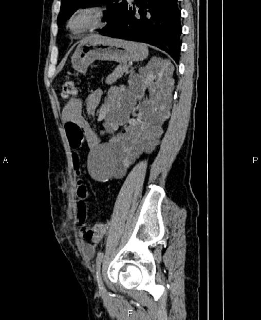 Autosomal dominant polycystic kidney disease (Radiopaedia 87830-104287 C 67).jpg
