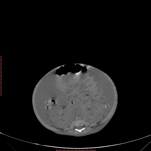 Autosomal recessive polycystic kidney disease associated with Caroli disease (Radiopaedia 61932-69984 Axial non-contrast 245).jpg