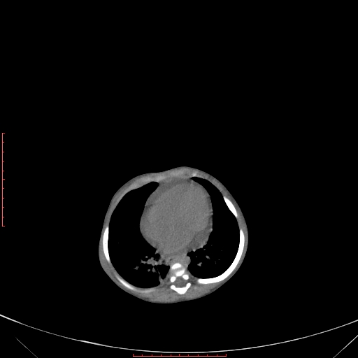 Autosomal recessive polycystic kidney disease associated with Caroli disease (Radiopaedia 61932-69984 B 86).jpg