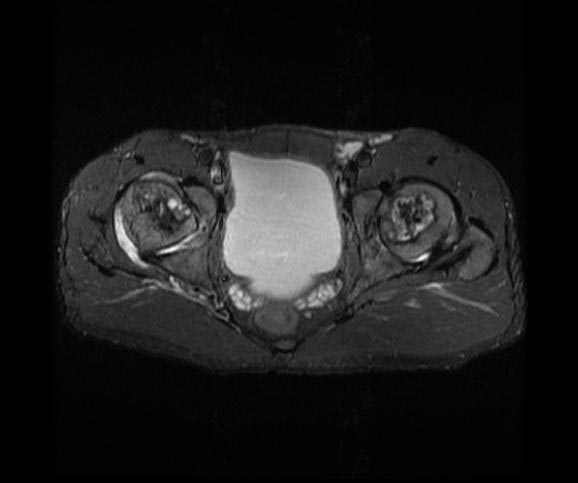 File:Avascular necrosis (Radiopaedia 11225-11590 F 1).jpg
