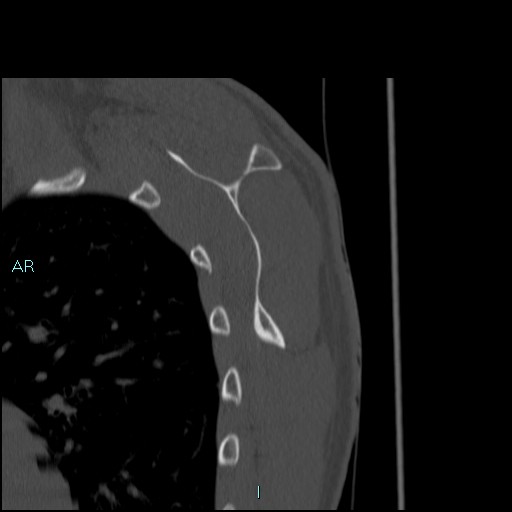 Avascular necrosis after fracture dislocations of the proximal humerus (Radiopaedia 88078-104653 Sagittal bone window 62).jpg