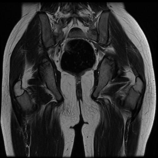 File:Avascular necrosis of the hip (Radiopaedia 29563-30067 Coronal T2 13).jpg