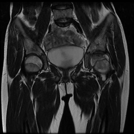 File:Avascular necrosis of the hip (Radiopaedia 29563-30067 Coronal T2 6).jpg