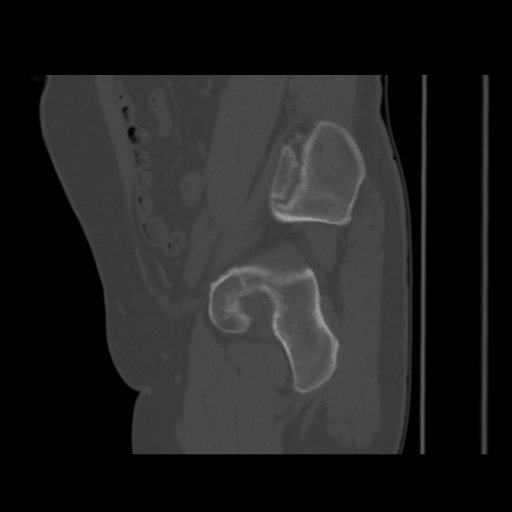 File:Avascular necrosis of the hip (Radiopaedia 61503-69467 B 20).jpg