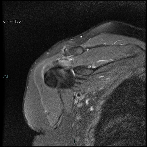 File:Avascular necrosis of the shoulder - Cruess stage I (Radiopaedia 77674-89886 Coronal PD fat sat 15).jpg