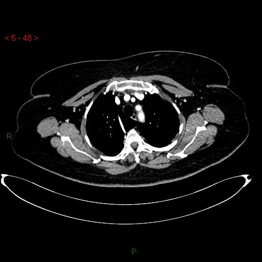 File:Azygos fissure and lobe (Radiopaedia 47620-52278 A 34).jpg
