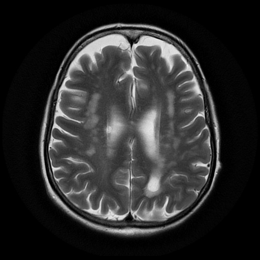 File:Balo concentric sclerosis (Radiopaedia 53875-59982 Axial T2 17).jpg