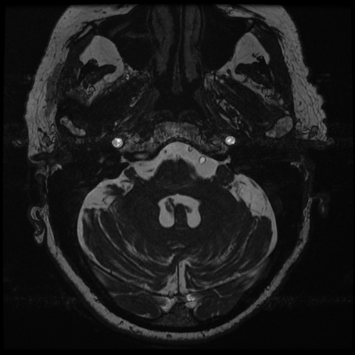 File:Balo concentric sclerosis (Radiopaedia 53875-59982 Axial T2 FIESTA 22).jpg