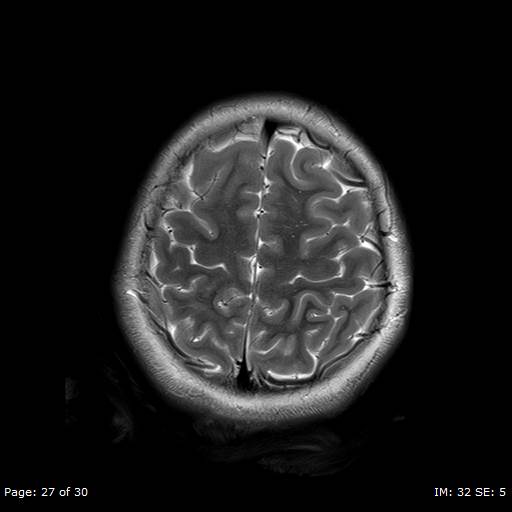 File:Balo concentric sclerosis (Radiopaedia 61637-69636 Axial T2 27).jpg