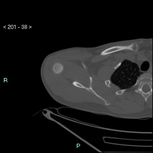 Bankart lesion with glenoid bone defect - assessment TC with PICO method (Radiopaedia 42855-93901 Axial bone window 37).jpg