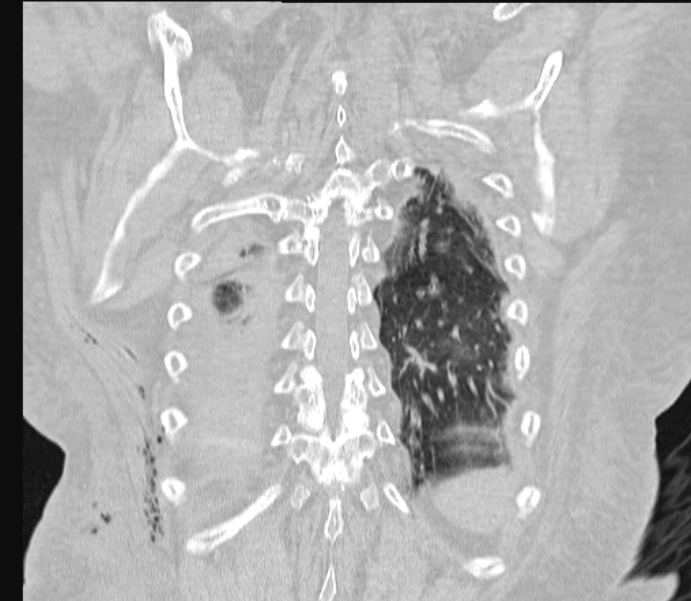 Barotrauma due to mechanical ventilation (Radiopaedia 28079-28336 Coronal lung window 77).jpg