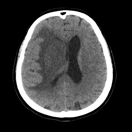 File:Basal ganglia metastasis (Radiopaedia 78928-91830 Axial non-contrast 39).png