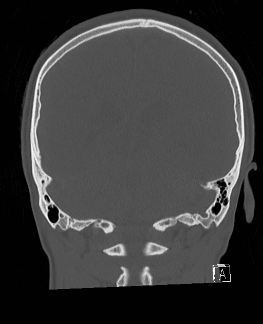 Base of skull fracture with bilateral Le Fort fractures (Radiopaedia 47094-51638 Coronal bone window 32).jpg